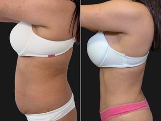 Abdominoplastía antes y después - 881190