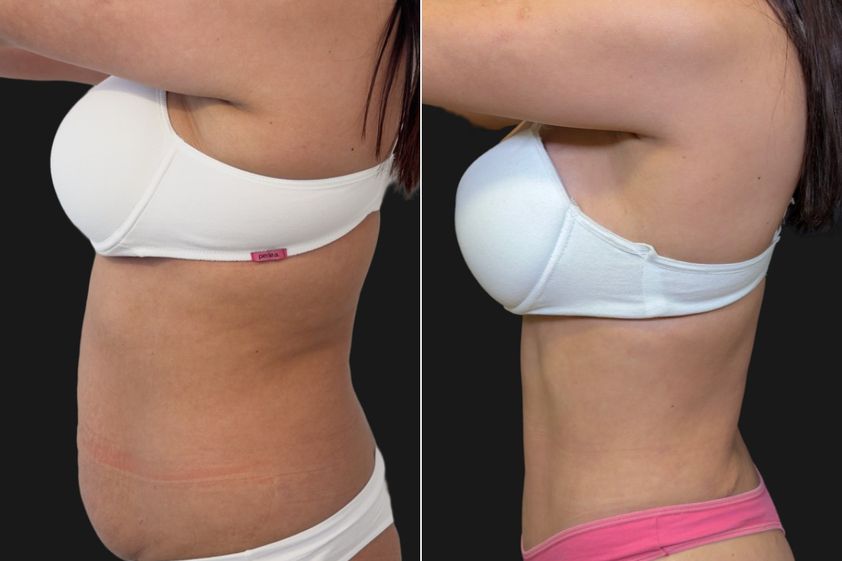 Abdominoplastía antes y después - 881190