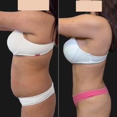 Abdominoplastia - Dr. Fernando Glaria