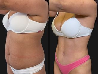 Abdominoplastía antes y después - 881191