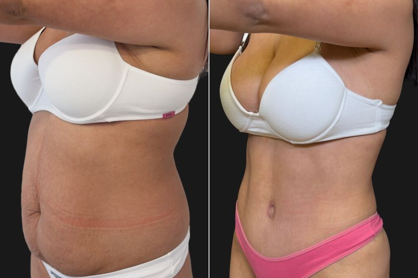 Abdominoplastía antes y después - 881191