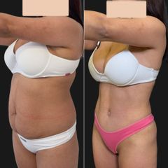 Abdominoplastia - Dr. Fernando Glaria