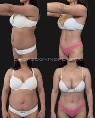 Lipoabdominoplastia - Dr. Fernando Glaria