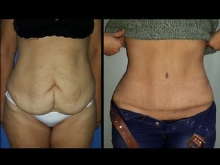 Abdoinomplastia