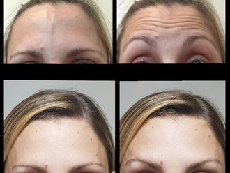 Botox - 631192