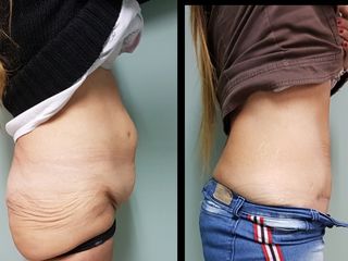 Abdominoplastia 