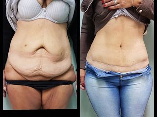 Abdominoplastia