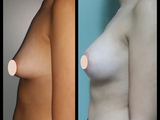Aumento mamario y corrección de mama tuberosa