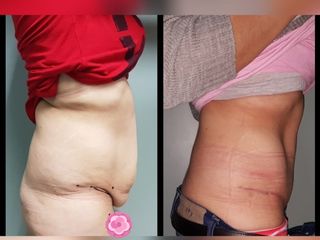 Abdominoplastia