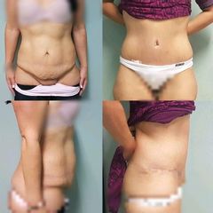 Abdominoplastia antes y después
