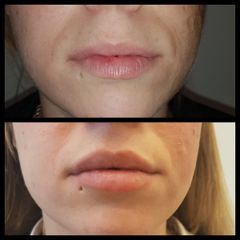 Relleno de labios con ácido hialurónico - antes y después