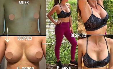 Aumento mamas - Dr. Leandro Di Carlo