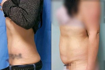 Abdominoplastia - Dr. Leandro Di Carlo