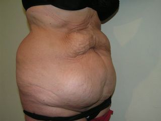 Abdominoplastia - antes