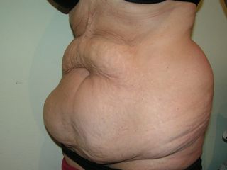 Abdominoplastia - antes