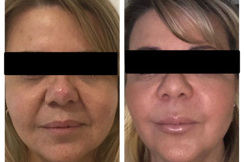 Rejuvenecimiento facial antes y después - 650025