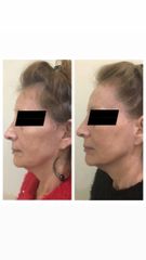 Rejuvenecimiento facial con toxina botulínica y hilos tensores