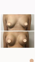 Implantes mamarios