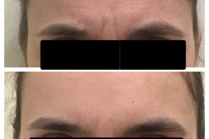 Botox antes y después - 650073