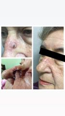 Escisión y reparación de tumores de piel