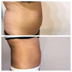 Liposucción - Dr. Víctor Armesto