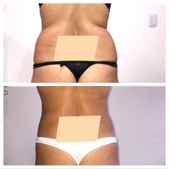 Liposucción - Dr. Víctor Armesto