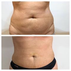 Liposucción - Dr. Víctor Armesto