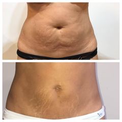 Liposucción - Dr. Víctor Armesto