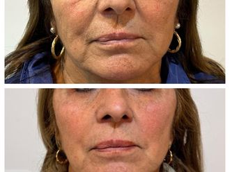 Blefaroplastia antes y después - 879753