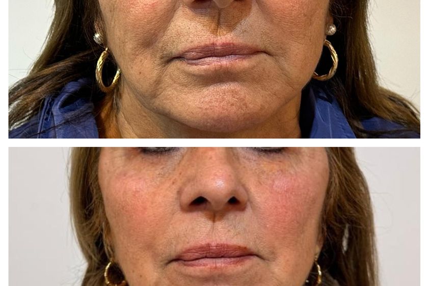 Blefaroplastia antes y después - 879753