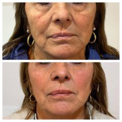 Blefaroplastia - Dr. Víctor Armesto