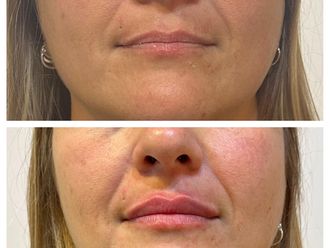 Relleno de labios antes y después - 879756