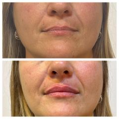 Aumento de labios