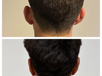 Otoplastia antes y después - 879757