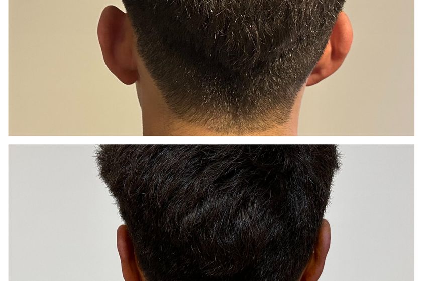 Otoplastia antes y después - 879757