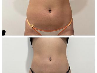 Lipoescultura antes y después - 879758