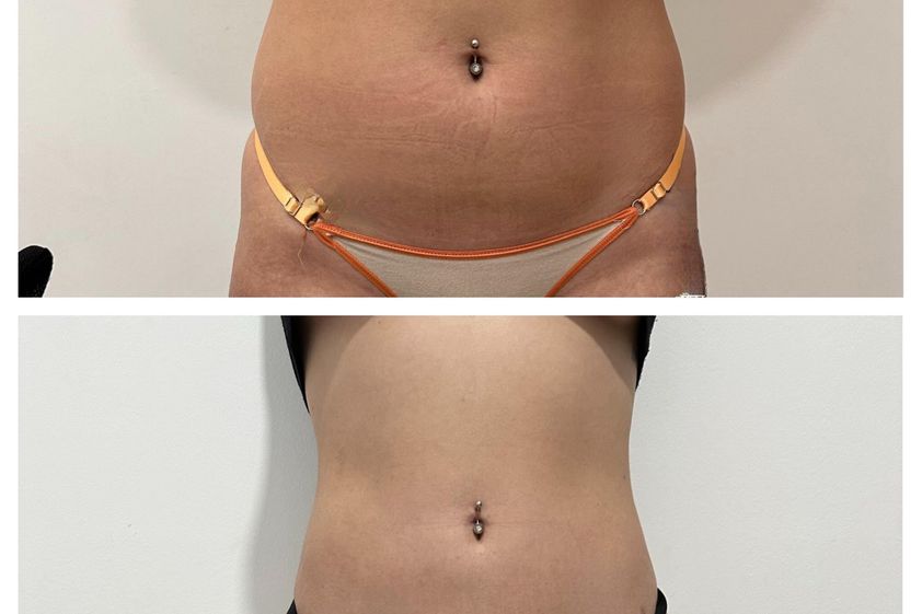 Lipoescultura antes y después - 879758