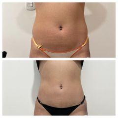 Lipoescultura