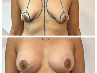Mastopexia antes y después - 879759