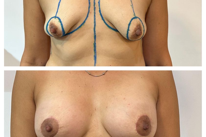 Mastopexia antes y después - 879759