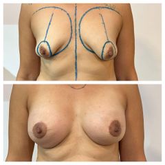 Mastopexia con implantes