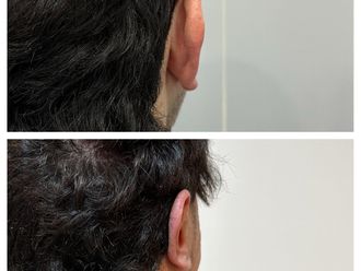 Otoplastia antes y después - 879761