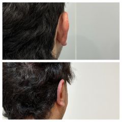 Otoplastia