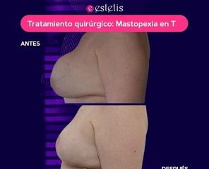 Mastopexia en T - Estetis