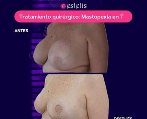 Mastopexia en T - Estetis