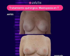 Mastopexia en T  - Estetis
