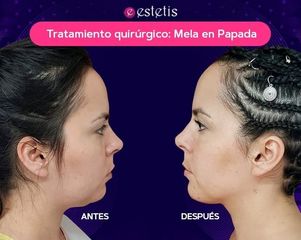 MELA en Papada - Estetis