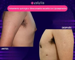 Ginecomastia resuelta con Lipoaspiración - Estetis