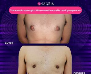 Ginecomastia resuelta con Lipoaspiración  - Estetis