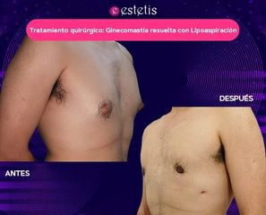 Ginecomastia resuelta con Lipoaspiración  - Estetis